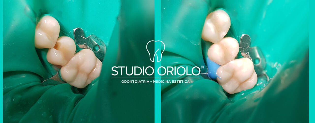 Studio Dentistico Oriolo | Lido di Ostia | Domande e Risposte sulle Otturazioni Dentali | Otturazione in Composito
