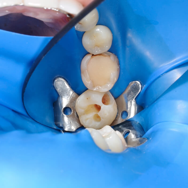 Studio Dentistico Oriolo | Lido di Ostia | La Diga Dentale | Conservativa
