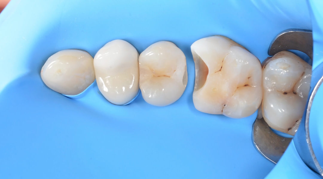 La Diga Dentale: Cos’è e a Cosa Serve