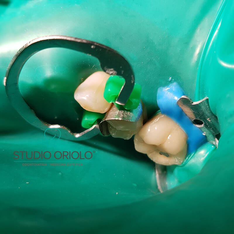 Studio Dentistico Oriolo | Lido di Ostia | La Diga Dentale | Otturazione