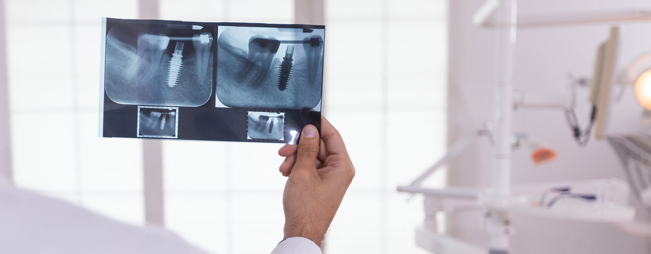 Studio Dentistico Oriolo | Lido di Ostia | Radiologia Odontoiatrica | Impianti Dentali