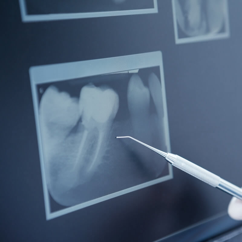 Studio Dentistico Oriolo | Lido di Ostia | Radiologia Odontoiatrica | Radiografia Endorale