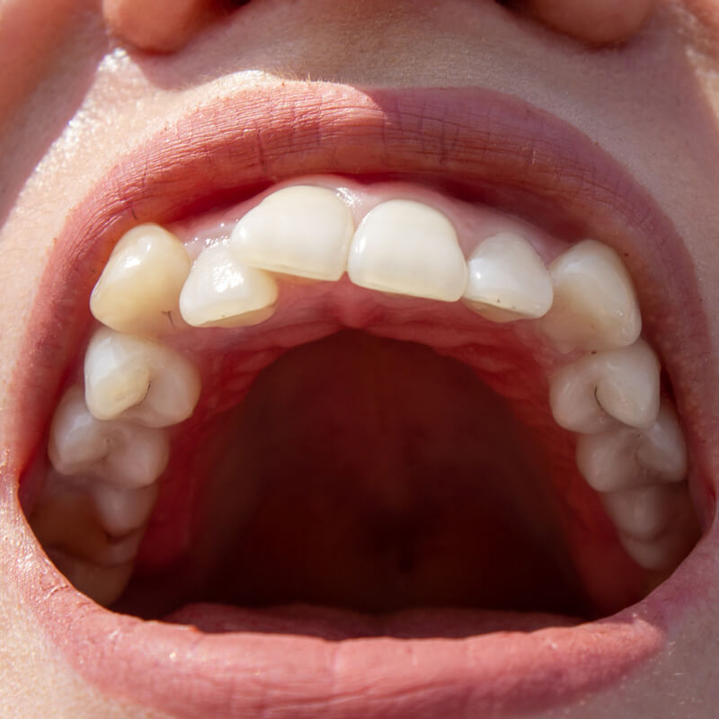 Studio Dentistico Oriolo | Lido di Ostia | Funzione Masticatoria e Crescita | Affollamento Dentale